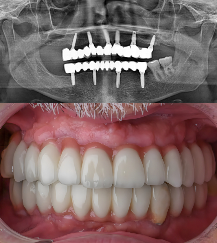 Impianti dentali sicuri e affidabili